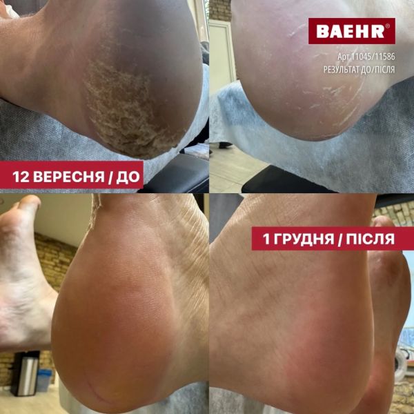 Бальзам із 10% сечовиною для ніг 125мл (SENSITIVE BALM SOFT), PEDIBAEHR