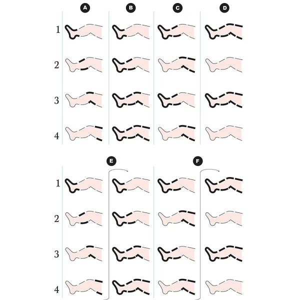 Лимфодренажный аппарат 6 камер OSD-FO-3001