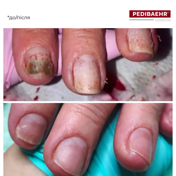 Масло для нігтів з протигрибковою дією 11мл (NAGELPFLEGEÖL) PEDIBAEHR