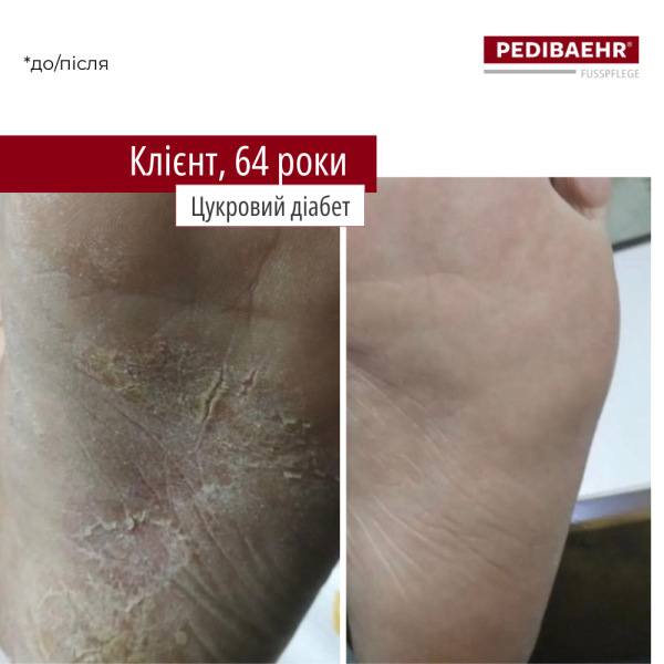 Крем з 10%-ою сечовиною для ніг 125 мл (PROTECTIVE FOOTCREAM), PEDIBAEHR