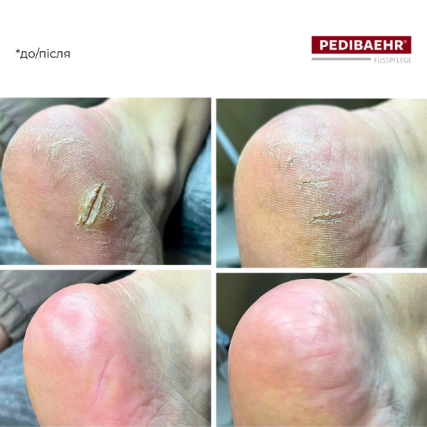 Крем для ніг зі 100%-вим оленячим жиром 125мл (DEER TALLOW CREAM), PEDIBAEHR