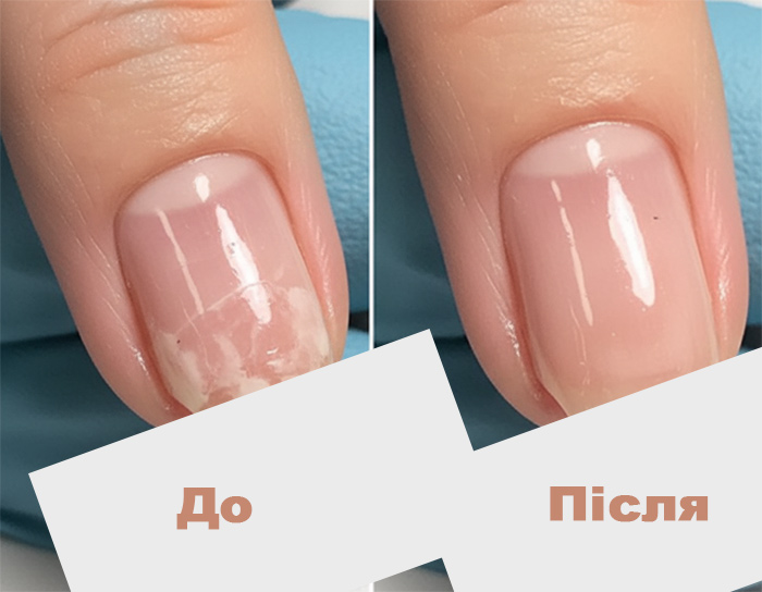 Результат лечения ногтей